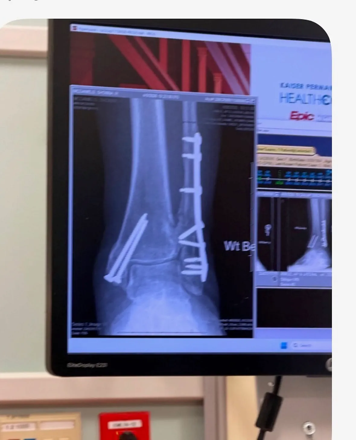An xray of injured foot