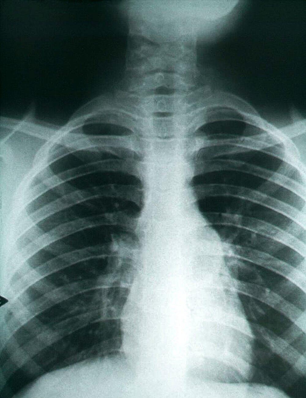 The cobweb-like shadows in this chest X-ray are signs of pulmonary fibrosis from Valley Fever. 