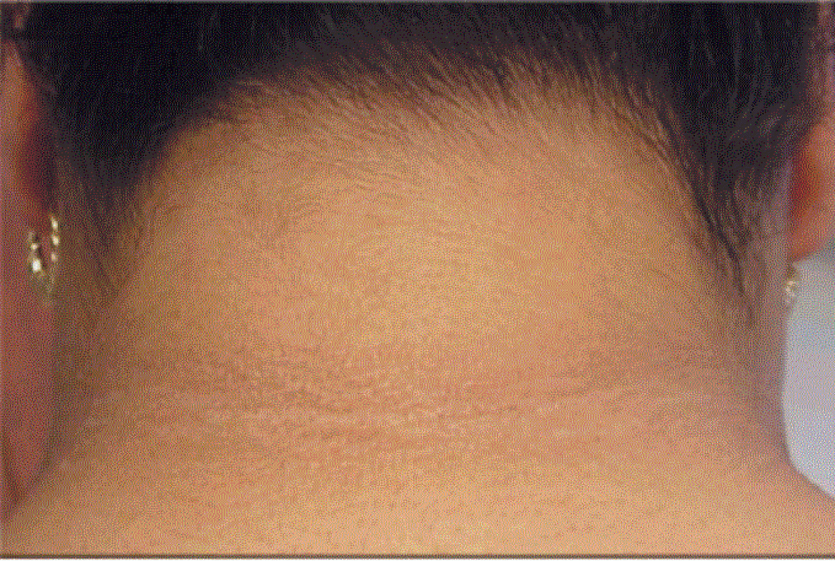 Acanthosis nigricans is the darkening of the back of the neck and can be an indicator of risk for type-2 diabetes. Acanthosis nigricans is the darkening of the back of the neck and can be an indicator of risk for type-2 diabetes.