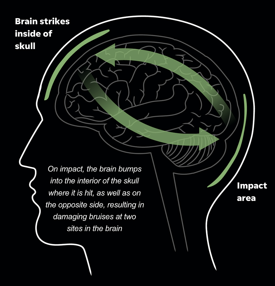 Illustration of human brain demonstrating the affected areas after impact