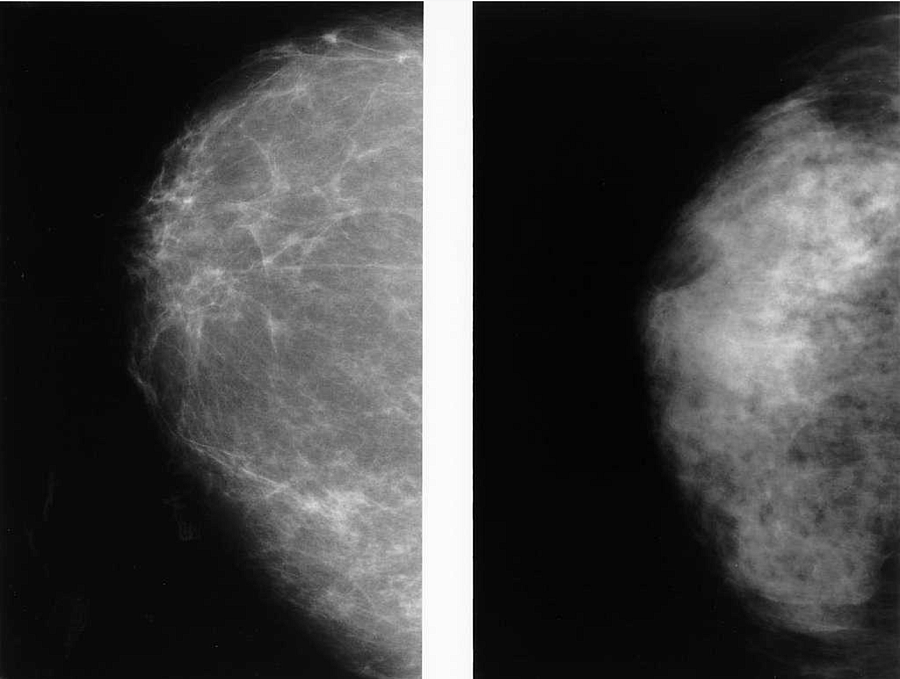 A mammography of two breasts. On the left is a dense breast and on the right is a fatty breast.