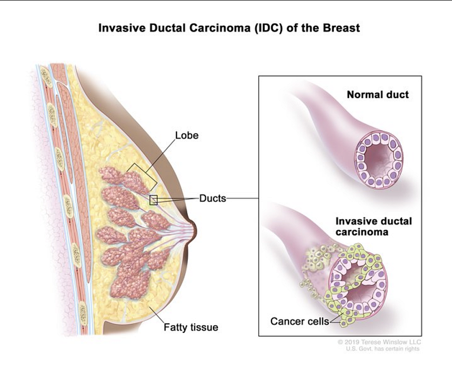 An illustration of breast development and cancer side by side