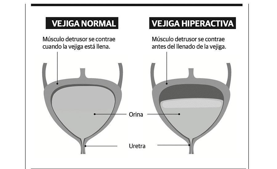 Image comparing normal and hyperactiva vejiga