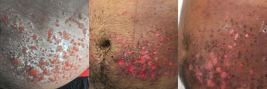 Skin adhesions