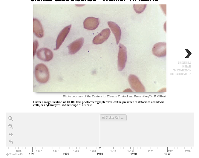 Timeline of Sickle Cell Disease