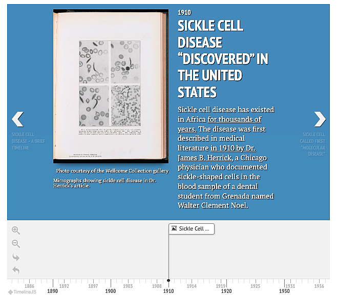 Timeline of Sickle Cell Disease