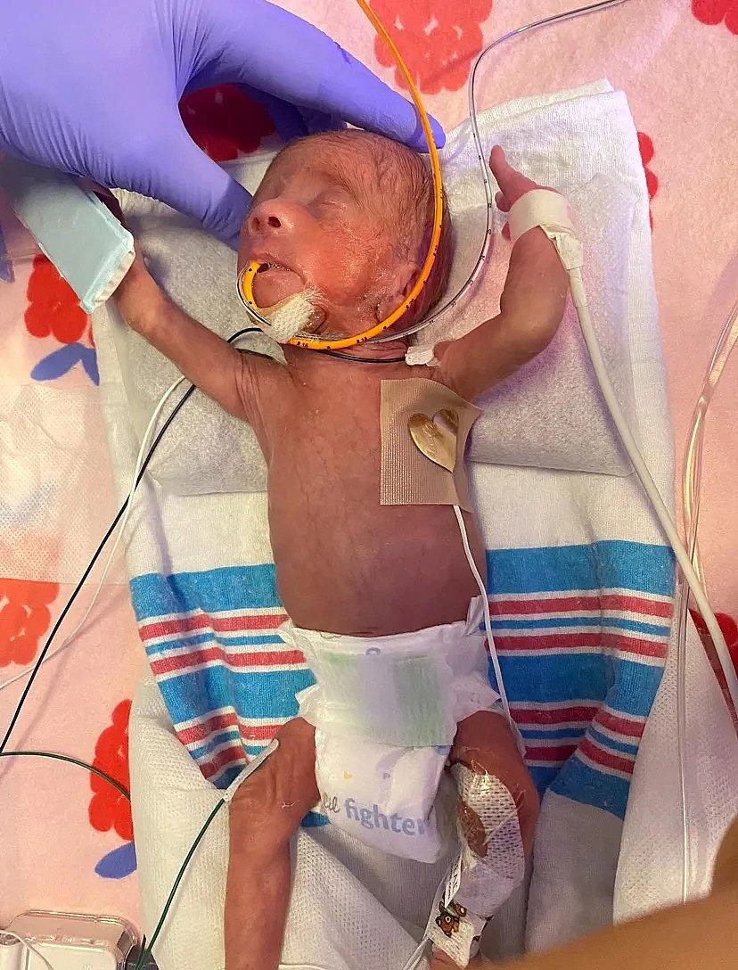 Image of a child born in preterm birth