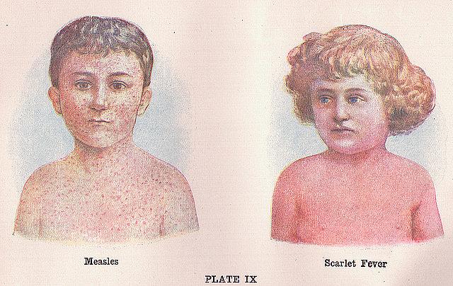 Measles is back. Measles is back in a big way.