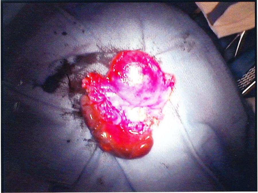 Pancreatic Net - Health Advocacy Pancreatic Neurondocrine Tumor