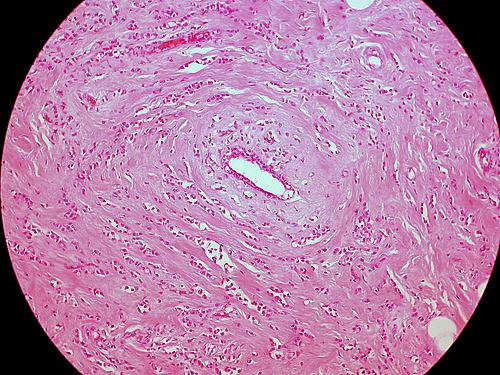 Classic Invasive Lobular Carcinoma of the Breast