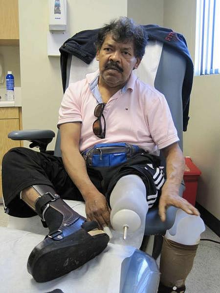 Salgado shows the prothesis he uses after his leg leg was amputated below the knee. (Francisco Castro)