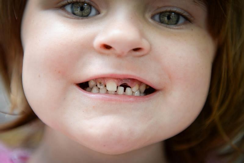 Keriana Carll, 4, recently had her front tooth pulled. Her mother, Megan Johnson, searched for months to find a dentist who was willing to accept Keriana’s Medicaid insurance. Staff Photo/Rachel S. O'Hara