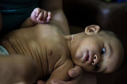 Discolored blotches, caused by a respiratory infection, are barely visible on Jasmin's chest after a course of antibiotics. Angelica said the doctor told her the infection was caused by mold growing in her home. [Photo by Angela Piazza]