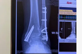 An xray of injured foot