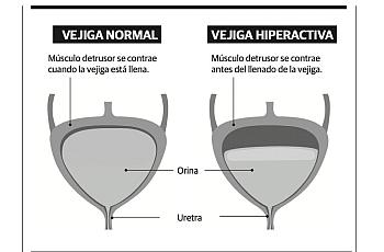 Image comparing normal and hyperactiva vejiga