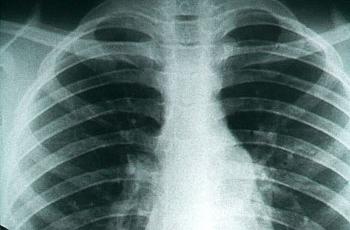 The cobweb-like shadows in this chest X-ray are signs of pulmonary fibrosis from Valley Fever. 