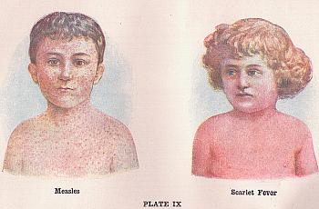 Measles is back in a big way.