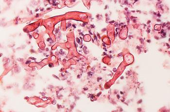Mucormycosis