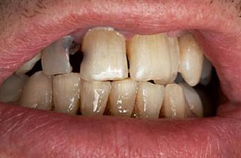 Bad Teeth a Barrier to Health and Jobs