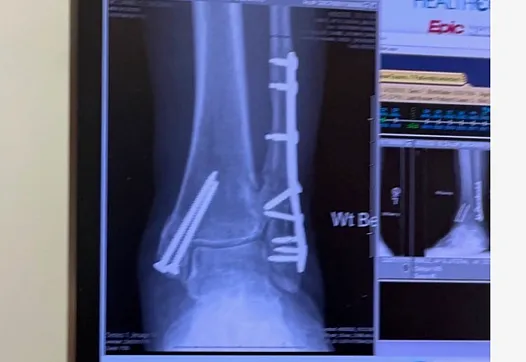 An xray of injured foot