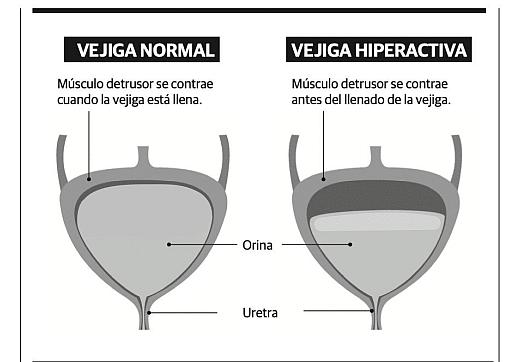 Image comparing normal and hyperactiva vejiga