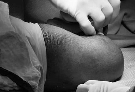 Vascular surgeon Sammy Siada prepares for an amputation procedure.