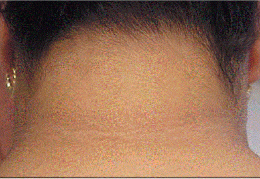 Acanthosis nigricans is the darkening of the back of the neck and can be an indicator of risk for type-2 diabetes.