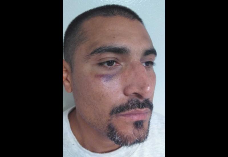 Immigrant detainee Abel Lopez Serrano said a deportation agent at the Adelanto ICE Processing Center assaulted him in September 2018, leaving him with a black eye.(Abel Lopez Serrano)