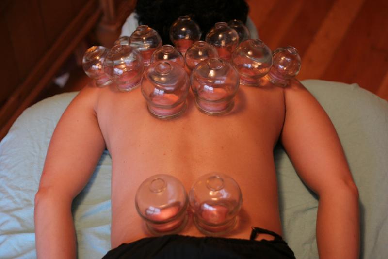 cupping, alternative medicine, reporting on health, NCCAM, paul offit, health journalism