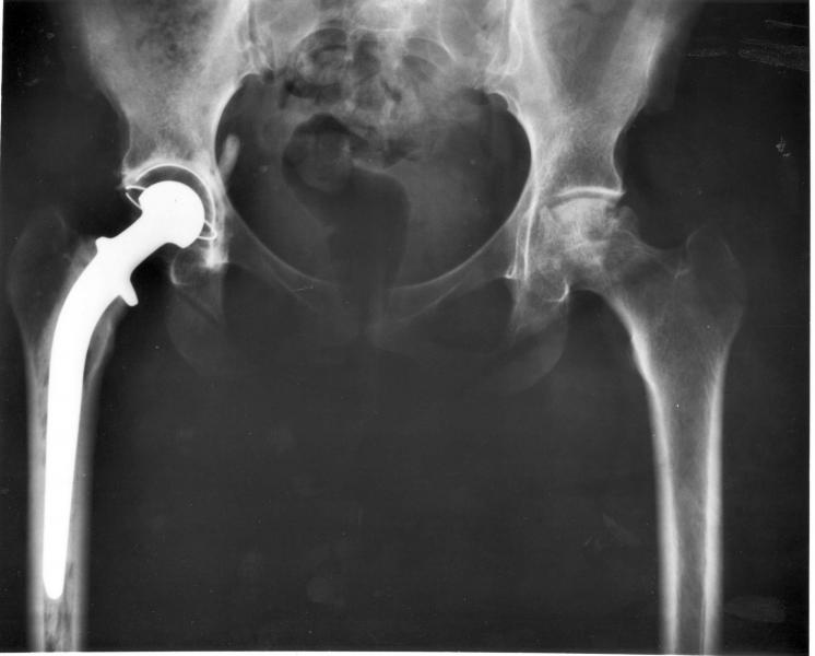 hip replacement, medical devices, patient safety, reporting on health, health journalism